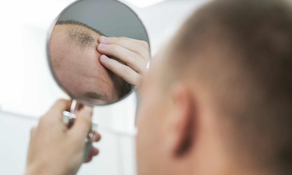 adult male having balding problems scaled