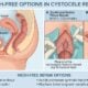 cystocele repair
